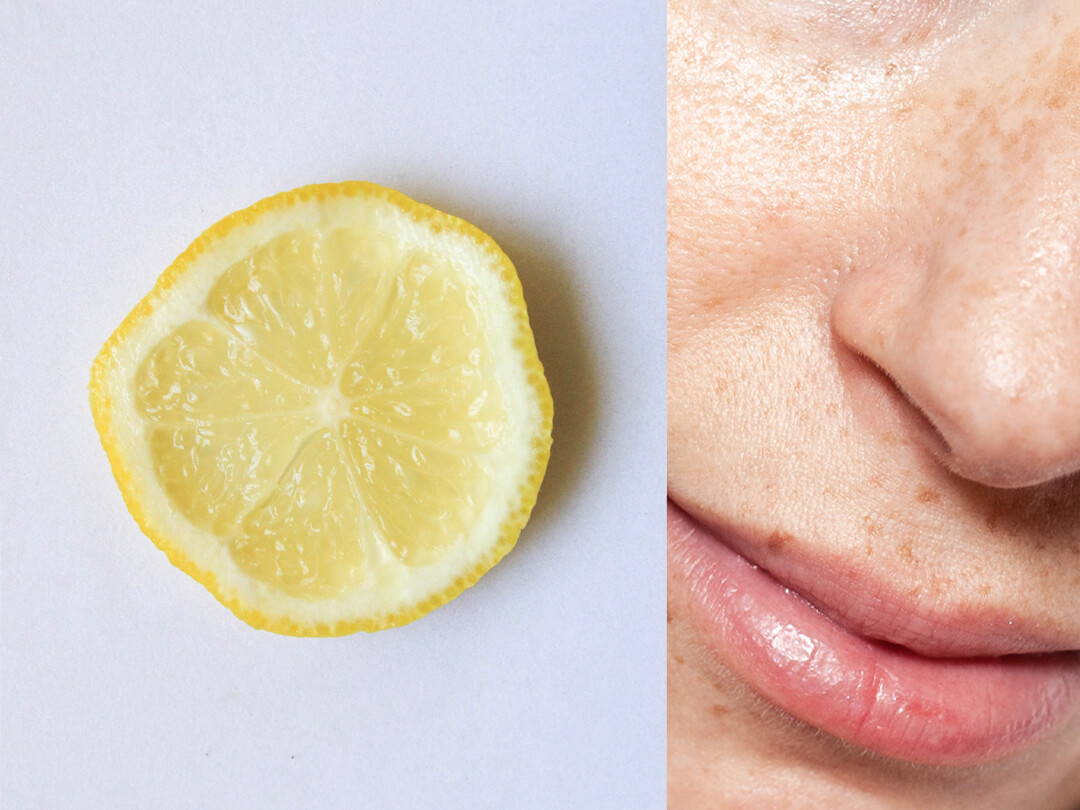 Auf natürliche Weise im Gesicht Pigmentflecken entfernen: 5 effektive Tipps für ebenmässige Haut